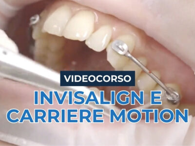 Invisalign e Carriere Motion – il trattamento ortodontico delle classe II e III