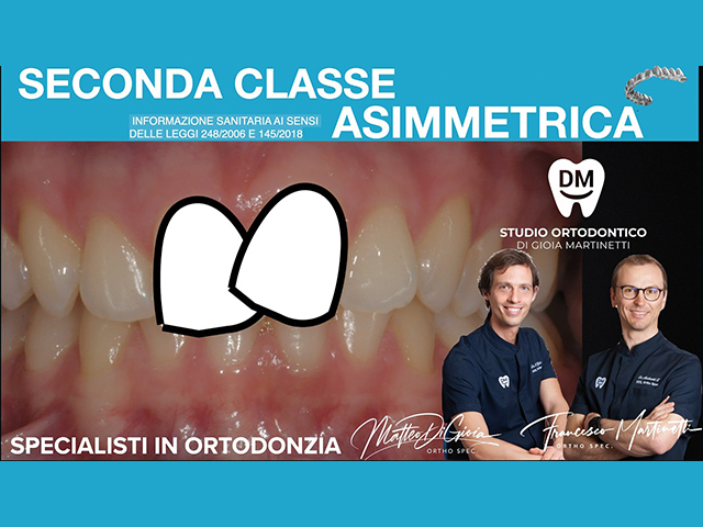 Seconda Classe asimmetrica nell’adulto: trattamento con allineatori, Carriere Motion e minivite