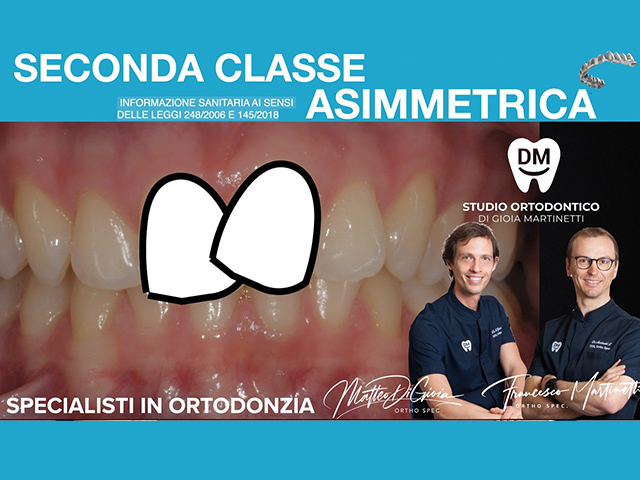 Seconda classe asimmetrica con allineatori: caso clinico